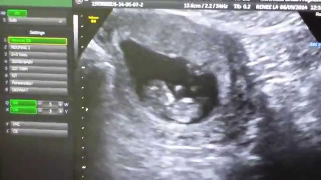 10 weeks pregnant ultrasound