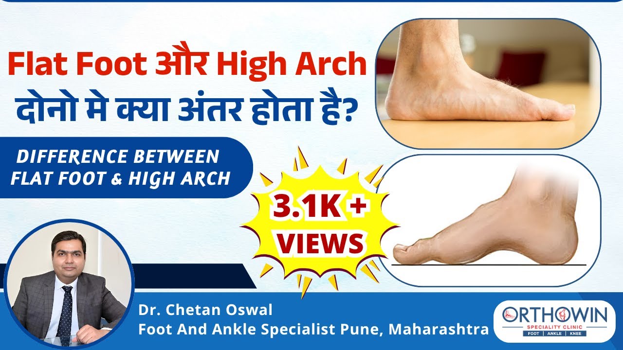 Flat Foot और High Arch दोनो मे क्या अंतर होता है? Difference Between Flat Foot & High Arch in Hindi