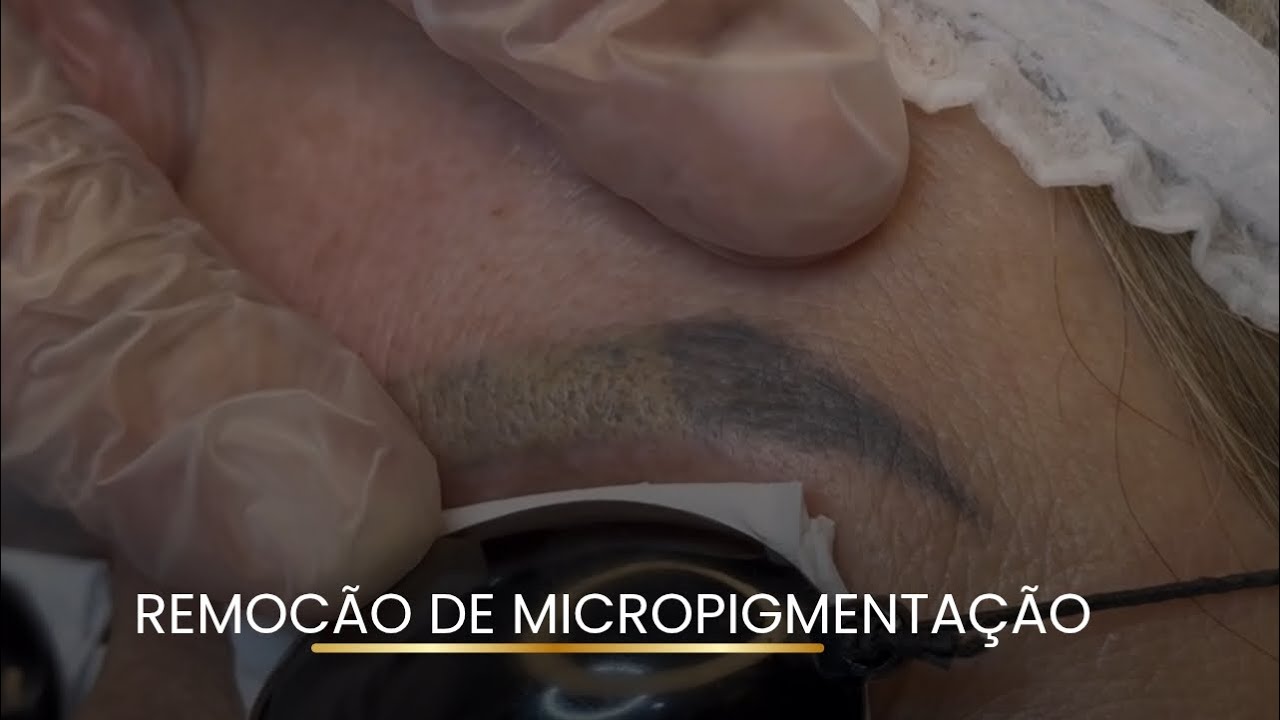REMOÇÃO MICROPIGMENTAÇÃO PRIMEIRA SESSÃO