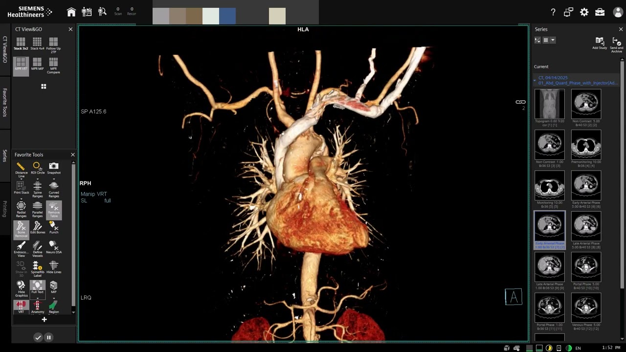 CT Chest & whole abdomen triphasic phase