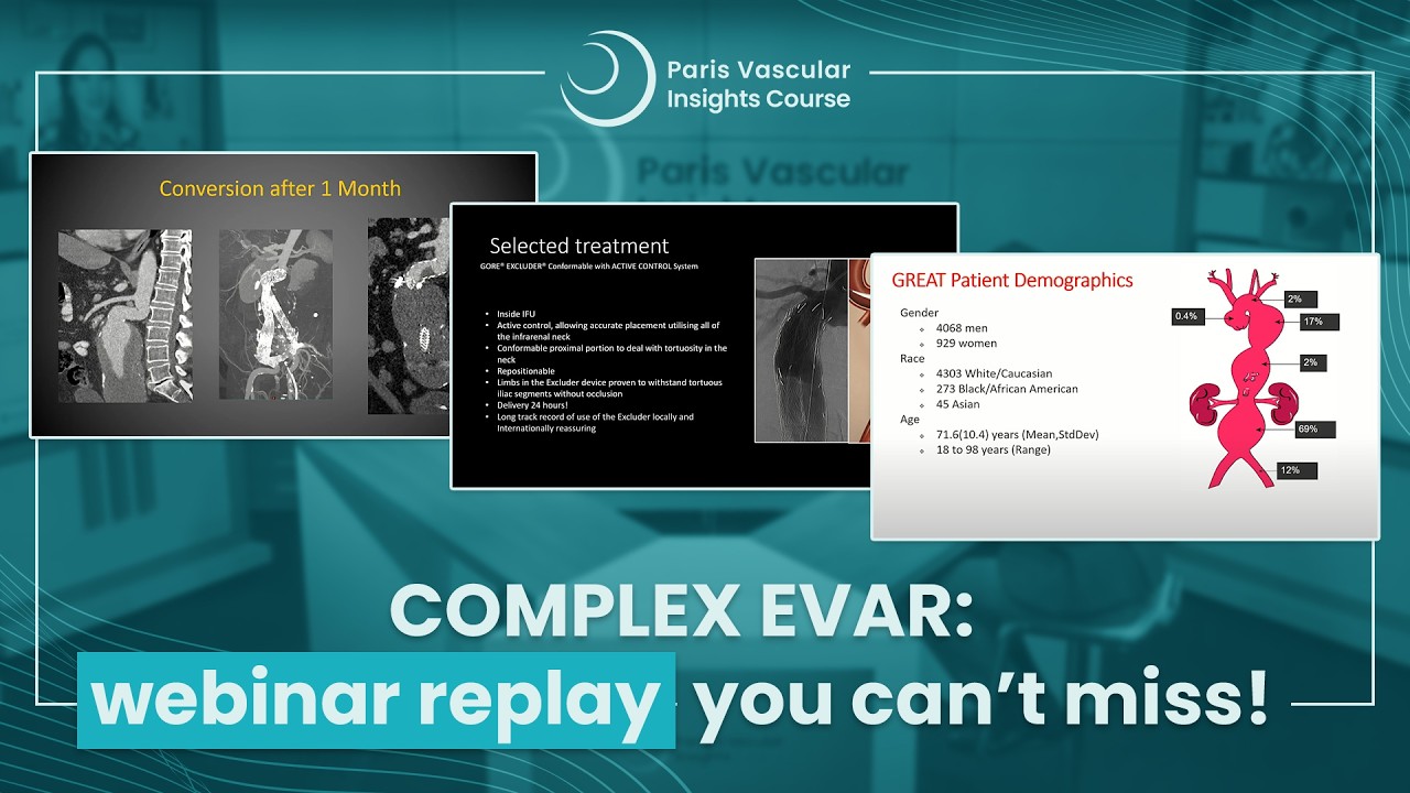 From routine to challenging – an EVAR overview based on decades of evidence and experience