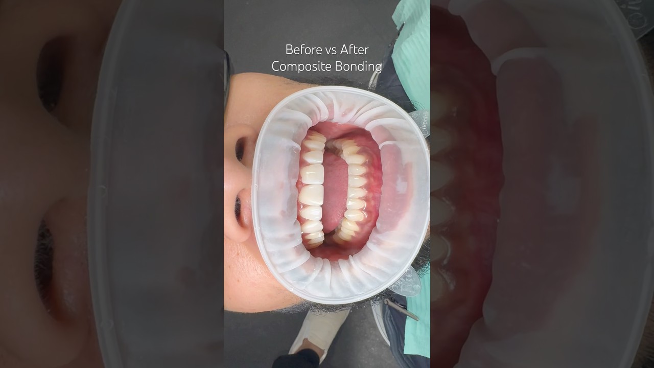 Composite bonding before vs after 🙌 #dentalbonding #smile