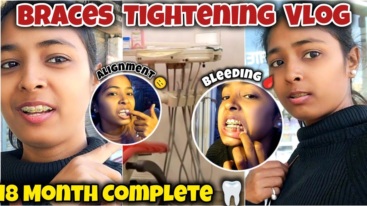 🦷😁18 Month Braces Tightening Day Vlog || Bleeding, Pain, Confidence 🥹 Miss Archu Vlogs #trending 