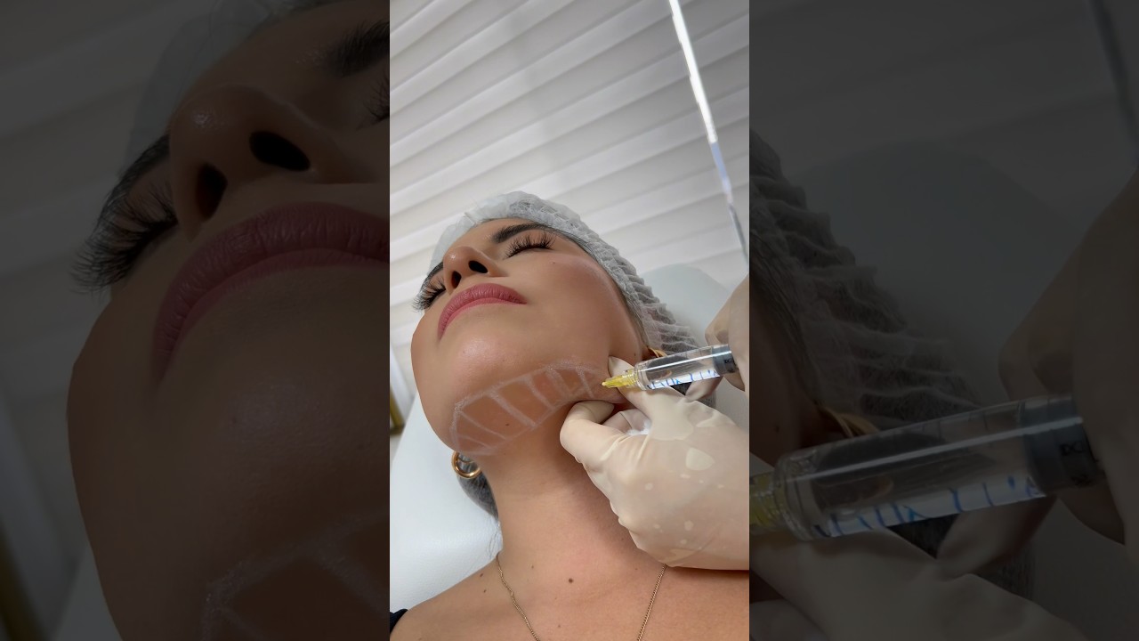 ADIOS A LA PAPADA CON ENZIMAS RECOMBINANTES CON MI DOXTORA ANA SOFIA #enzimas #papada #botox #lipo