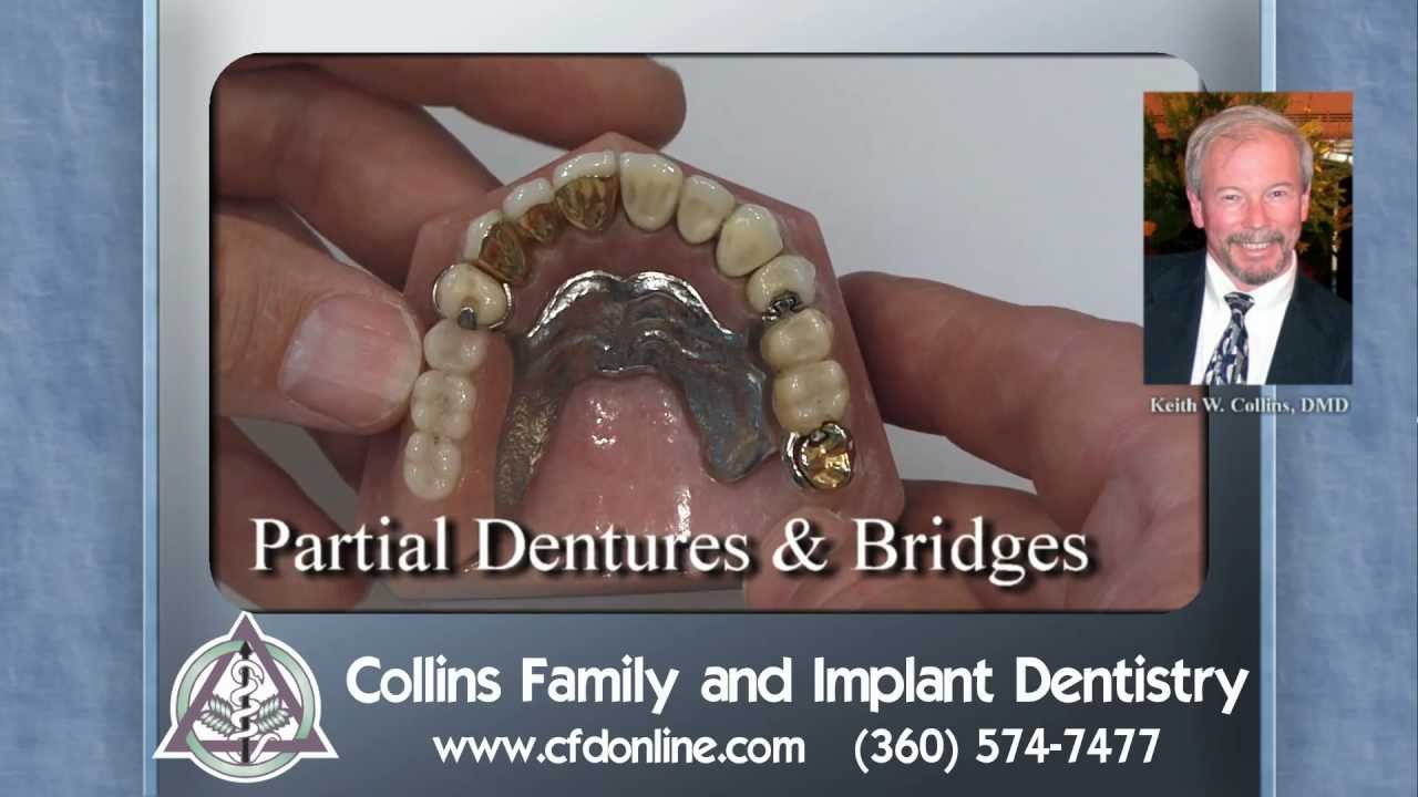 Partial dentures and bridges, hidden attachment systems