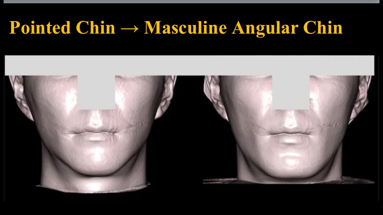 Pointed Chin → Masculine Angular Jaw