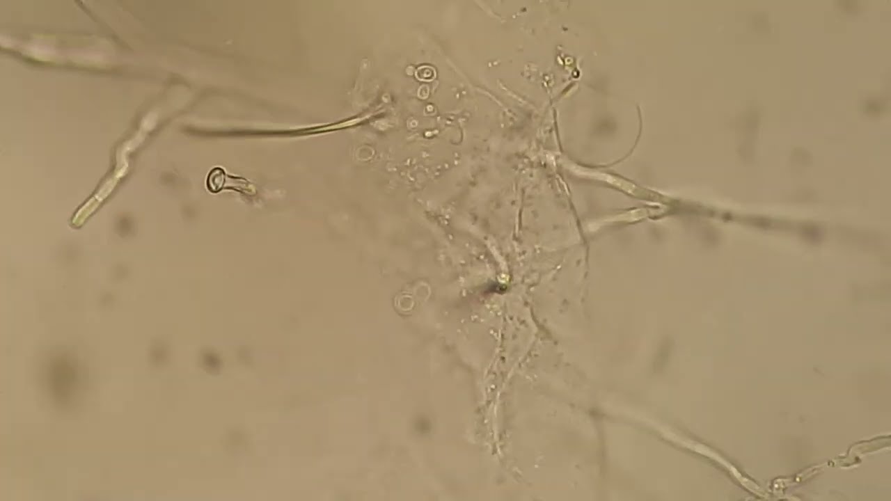 Fungal elements in KOH mount microscopy