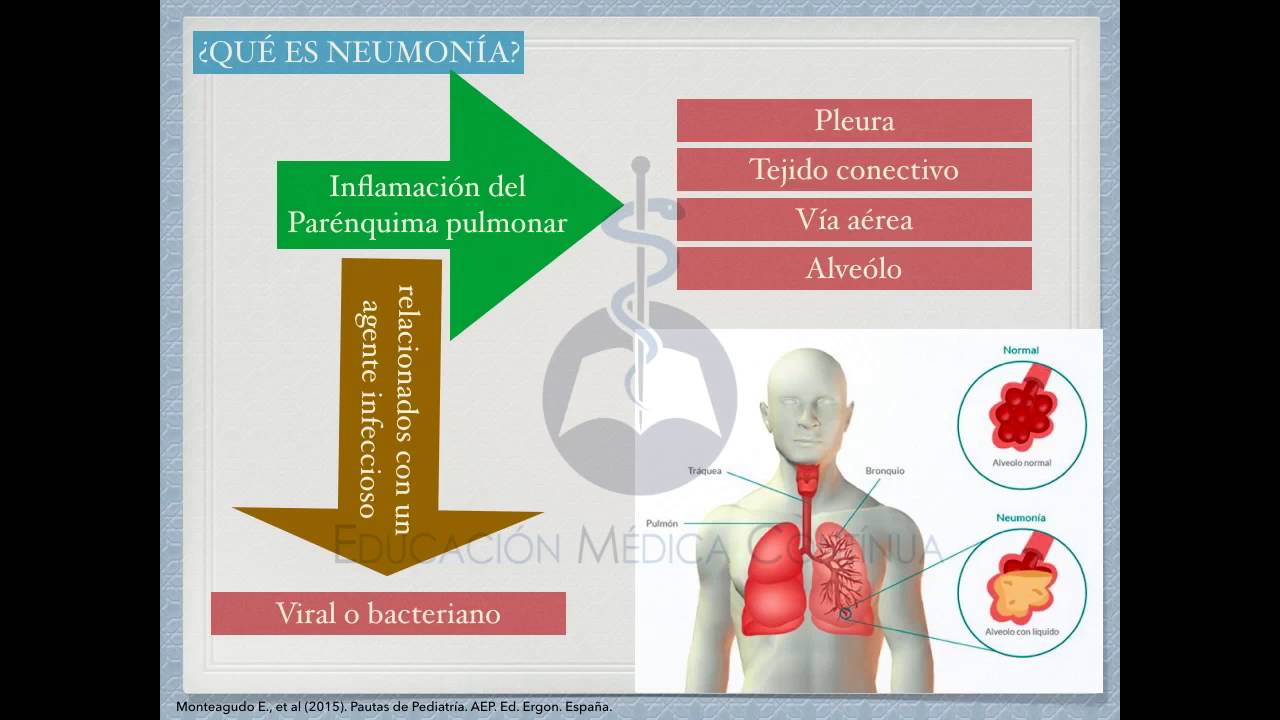 NEUMONÍA EN PEDIATRÍA