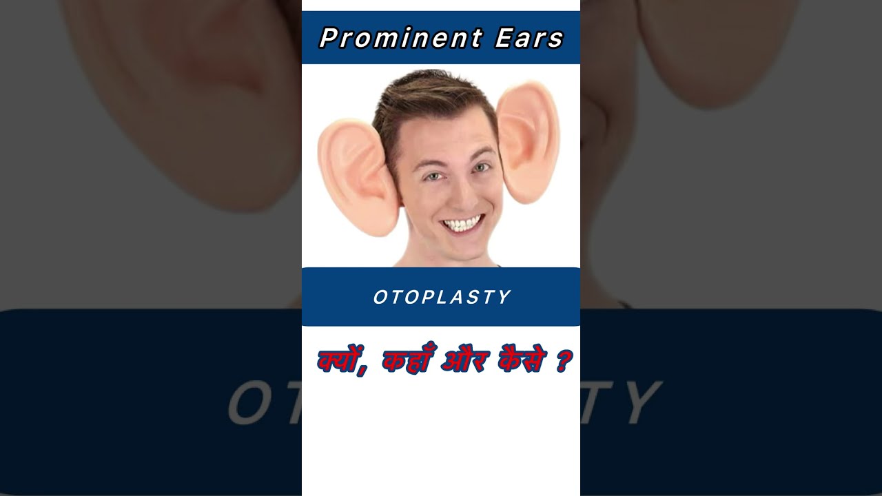 OTOPLASTY Prominent Ear Correction Surgery in Ahmedabad #otoplasty #batears  #prominentears #hdplus