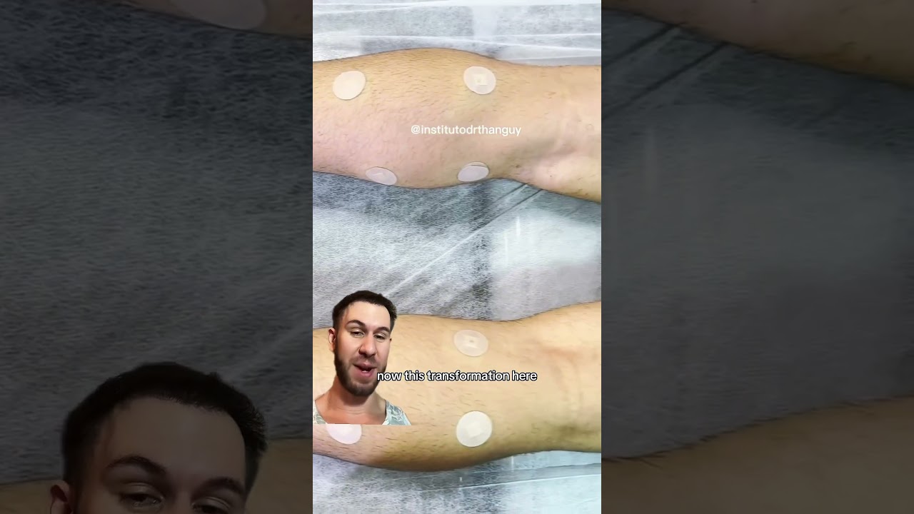 Is it Okay to get CALF IMPLANTS?! 
