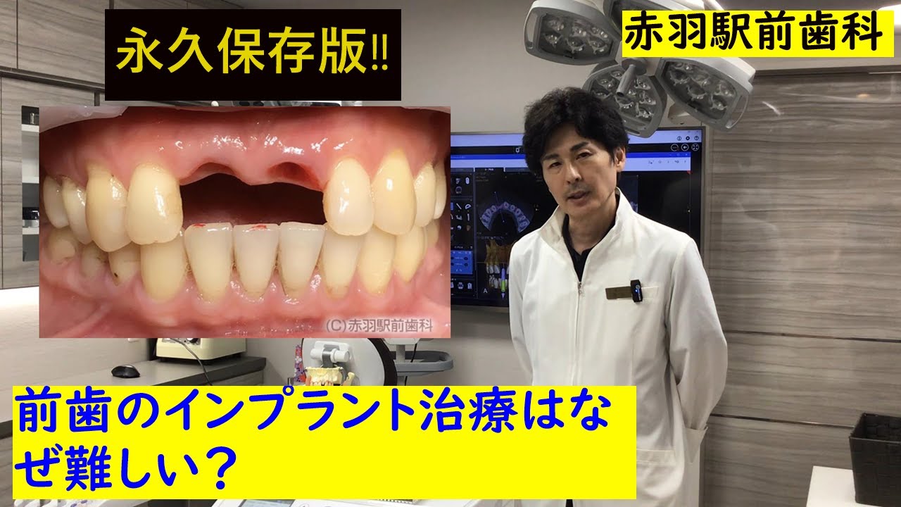 《前歯のインプラント治療について》　審美的に仕上げたいですよね？どうすればよい？
