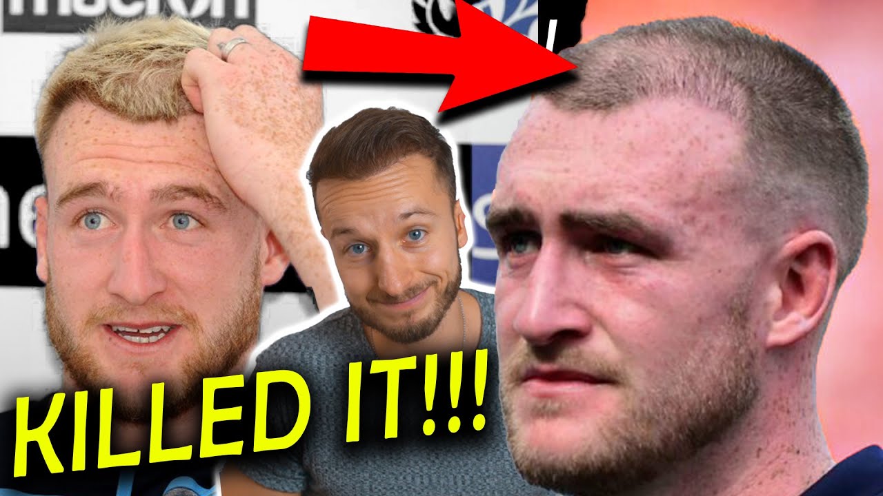 Stuart Hogg  Kills His Transplanted Hair by Accident!