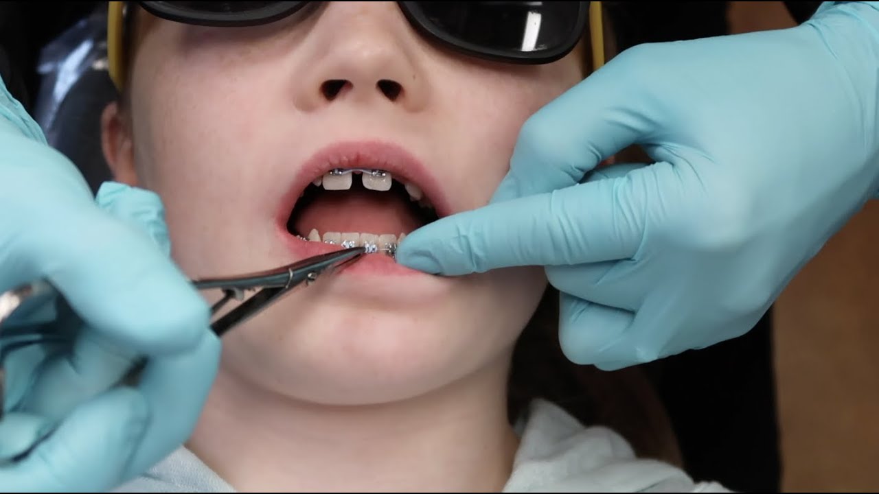 The Beginning of Lillian's Braces Transformation