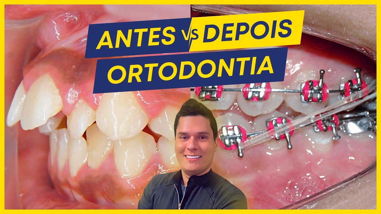 SENSACIONAL!!! Explicando COMO TRATEI 4 CASOS EM ORTODONTIA! (Antes x depois).