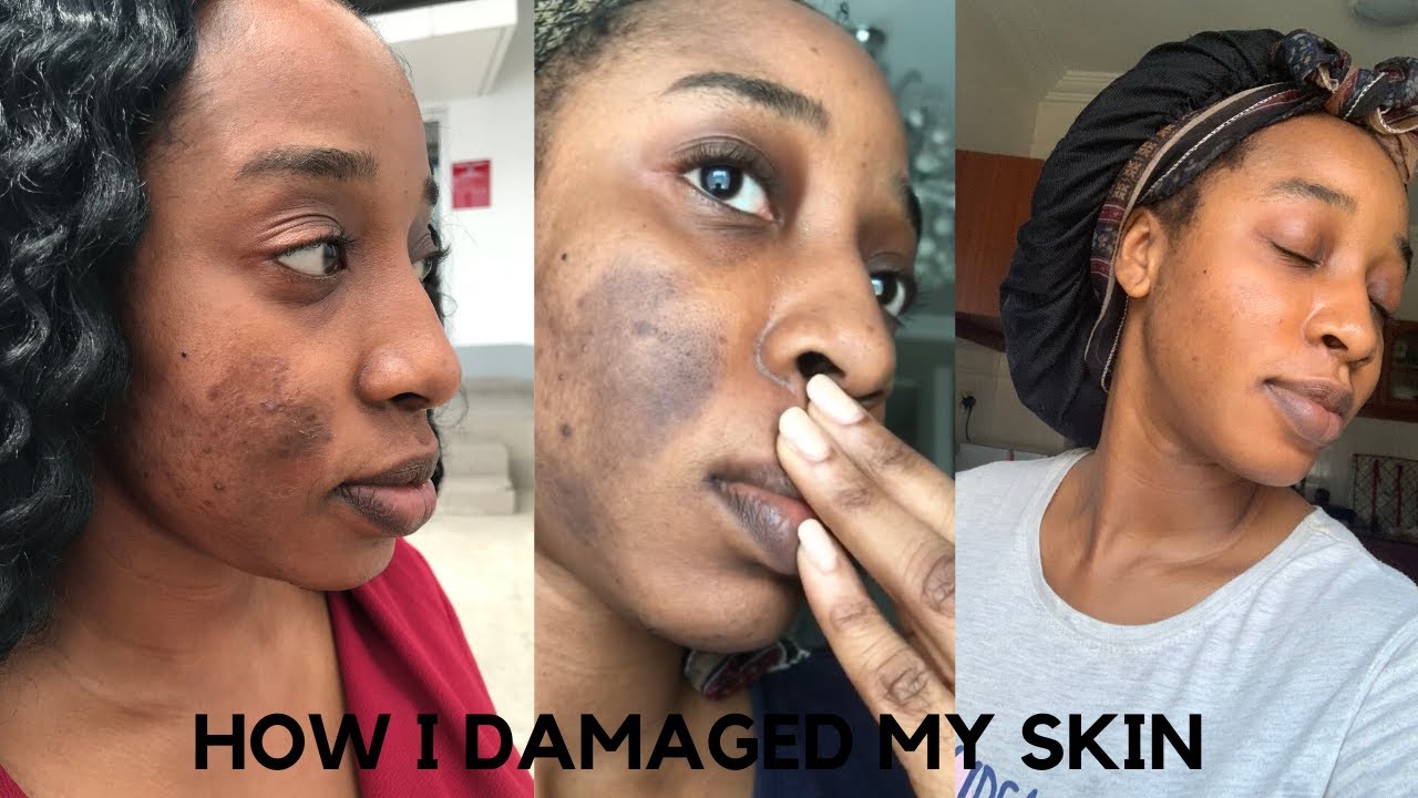 HOW I DAMAGED MY SKIN| LEARN FROM MY MISTAKES | SKINCARE |