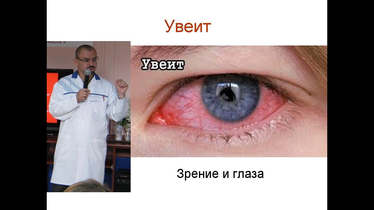 Увеит – аутоиммунное воспаление глаза. И его лечение.