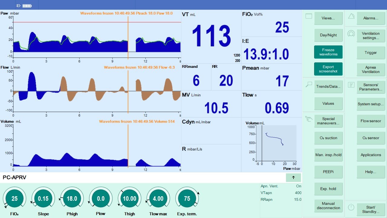 APRV / TCAV METHOD:  Quick Set Up & Adjustement