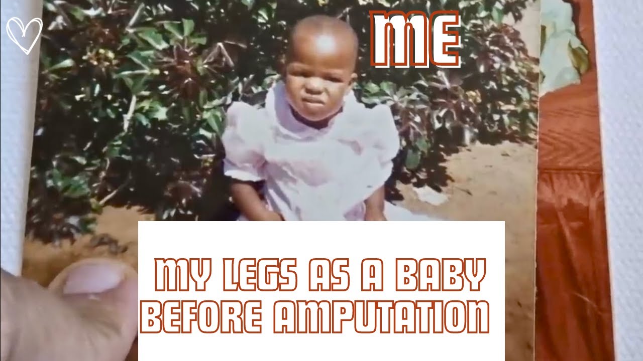 How my Legs Looked like before Amputation With Pictures