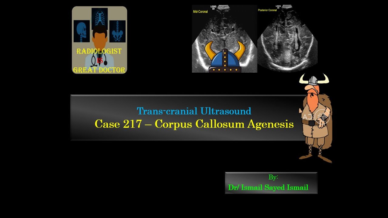 Ultrasound Case 217 - Corpus Callosum Agenesis