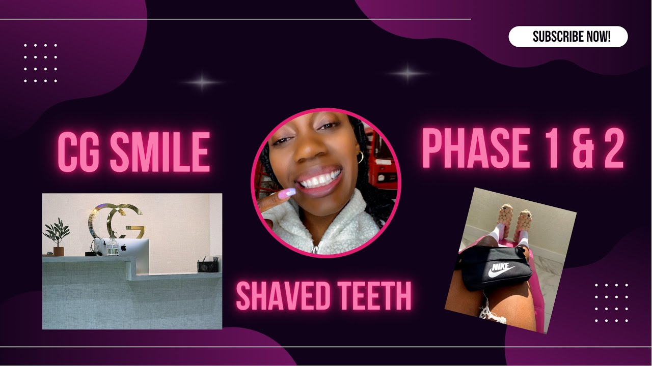 CG SMILE VENEER UPDATE (PHASE 1 & 2 + Shaved Teeth) #veneers #porcelainveneers