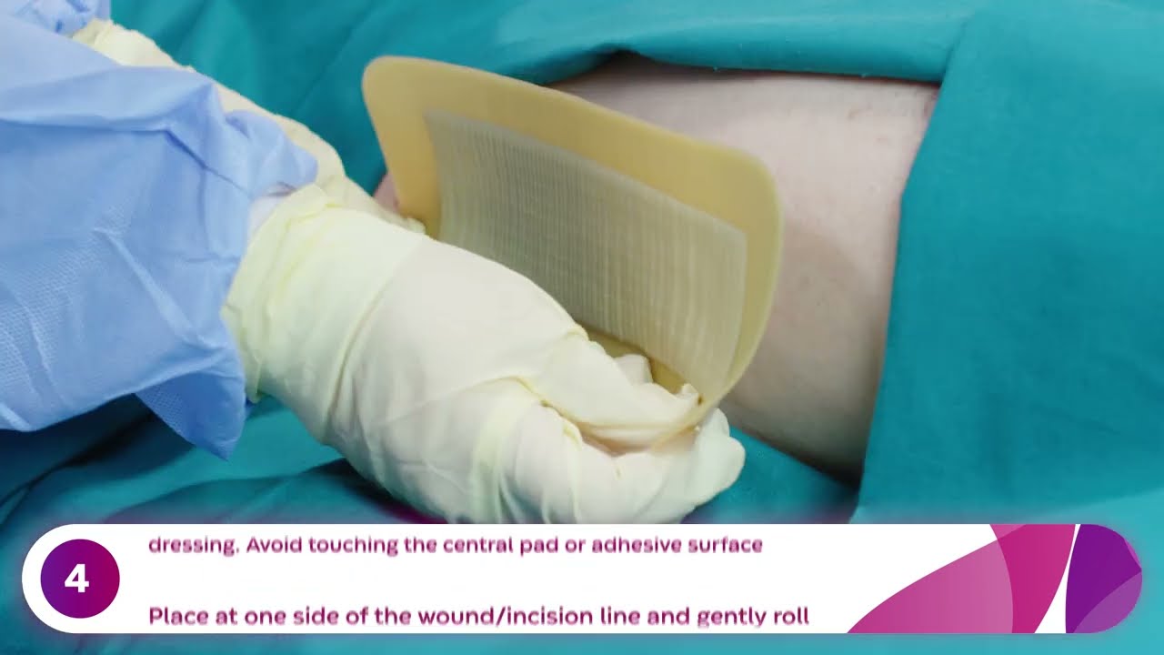 How to Apply and Remove Aquacel® Ag Surgical Dressings (Hip)