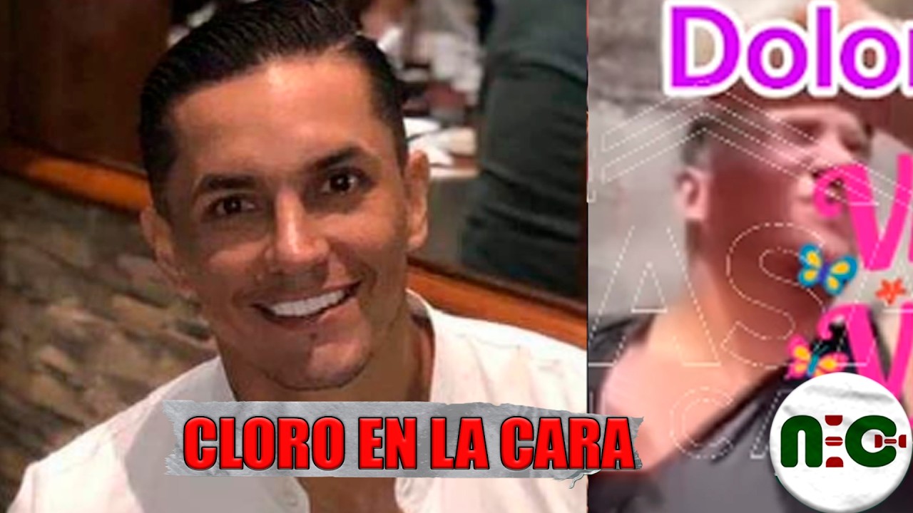 Toño Abril se baña con cloro y quema su rostro