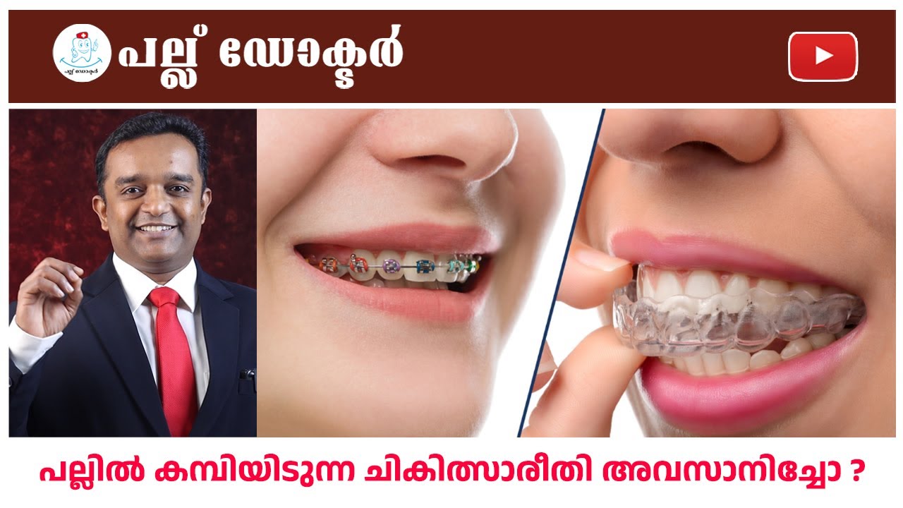 പല്ലിൽ കമ്പിയിടുന്ന ചികിത്സ അവസാനിച്ചോ? | Braces vs Aligners | Pallu Doctor