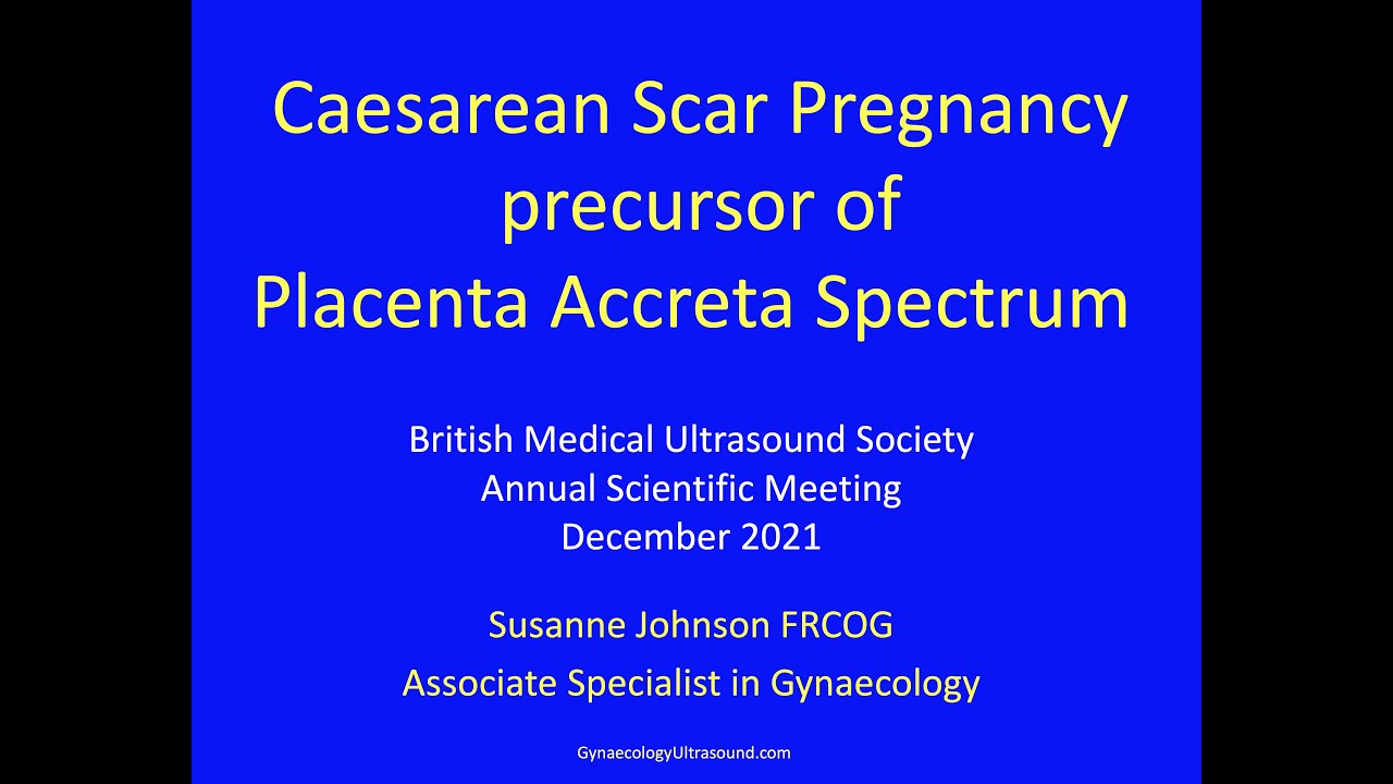 Caesarean Scar Pregnancy: precursor of Placenta Accreta Spectrum