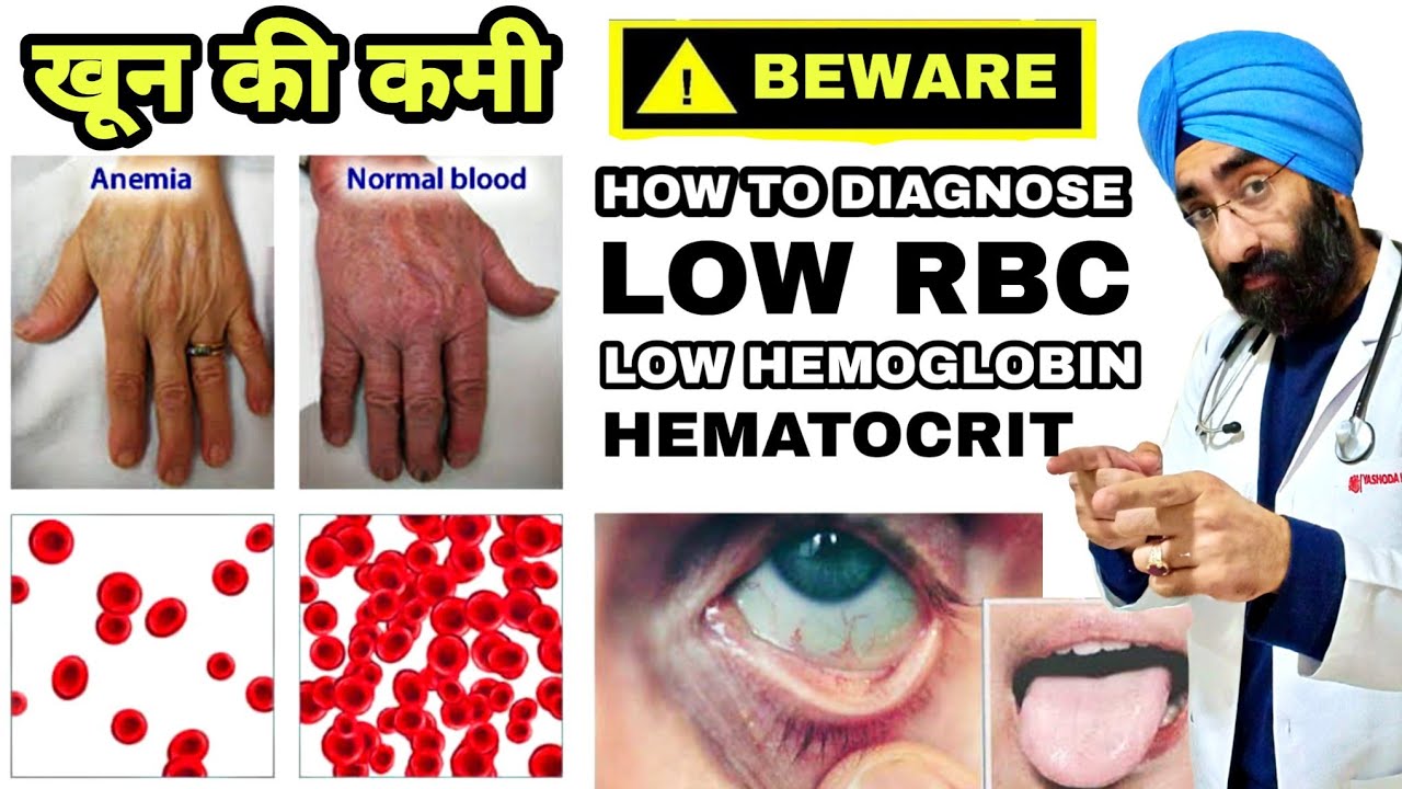 Khoon ki kami | ANEMIA - Low Hemoglobin, RBC Count, Hematocrit | Dr.Education (Hindi)