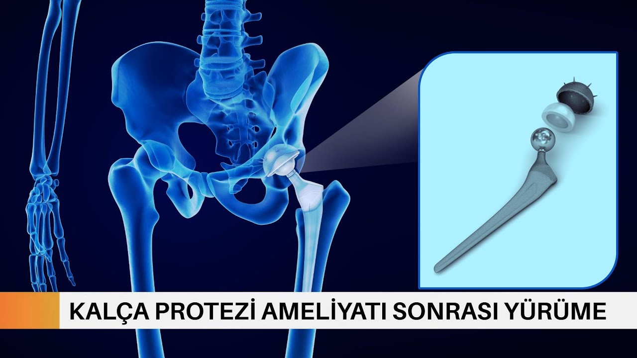 Kal&ccedil;a Protezi Ameliyatı Sonrası Y&uuml;r&uuml;me | Prof. Dr. Yakup YILDIRIM