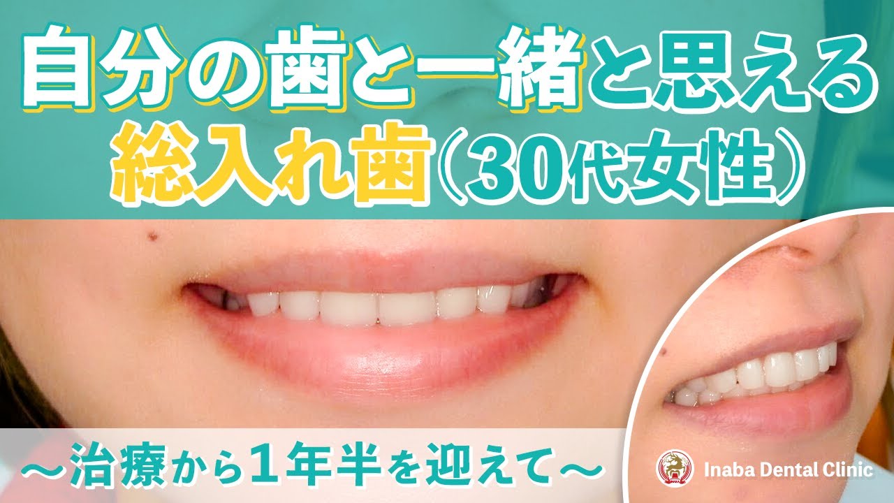 自分の歯と一緒と思える総入れ歯(30代女性)〜治療から1年半を迎えて〜