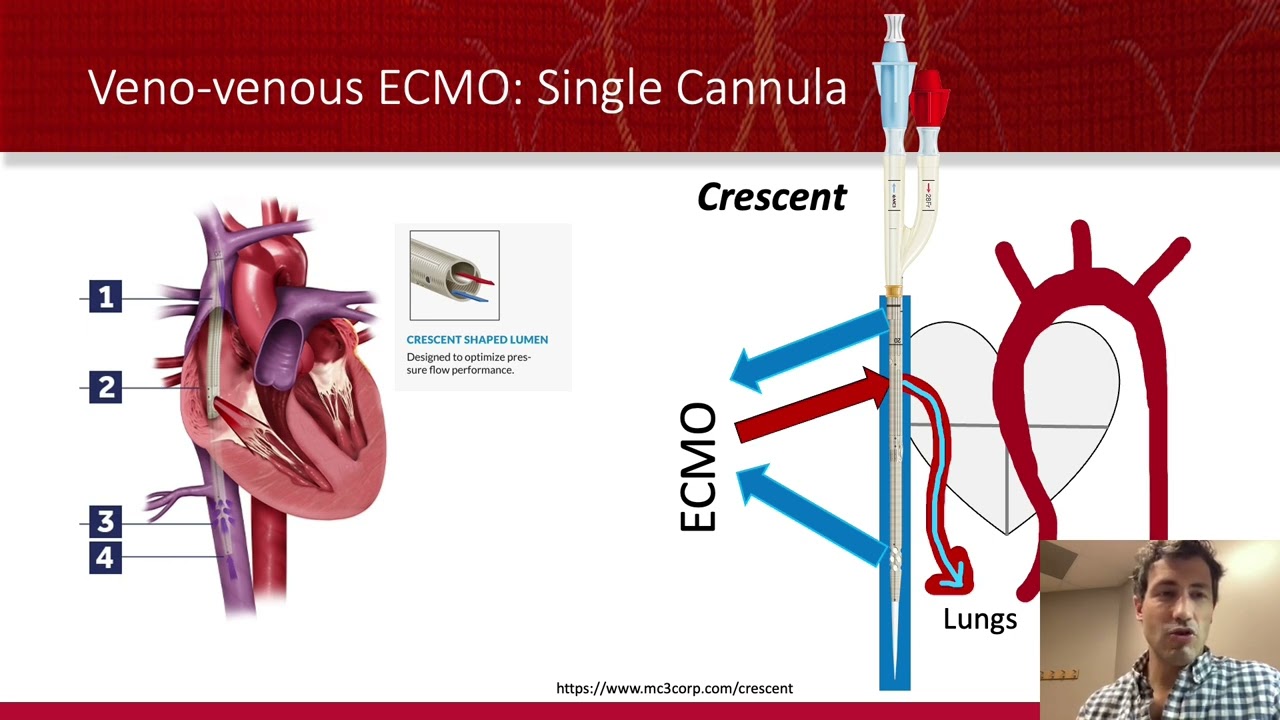 ECMO: Cannulation Calamaties!