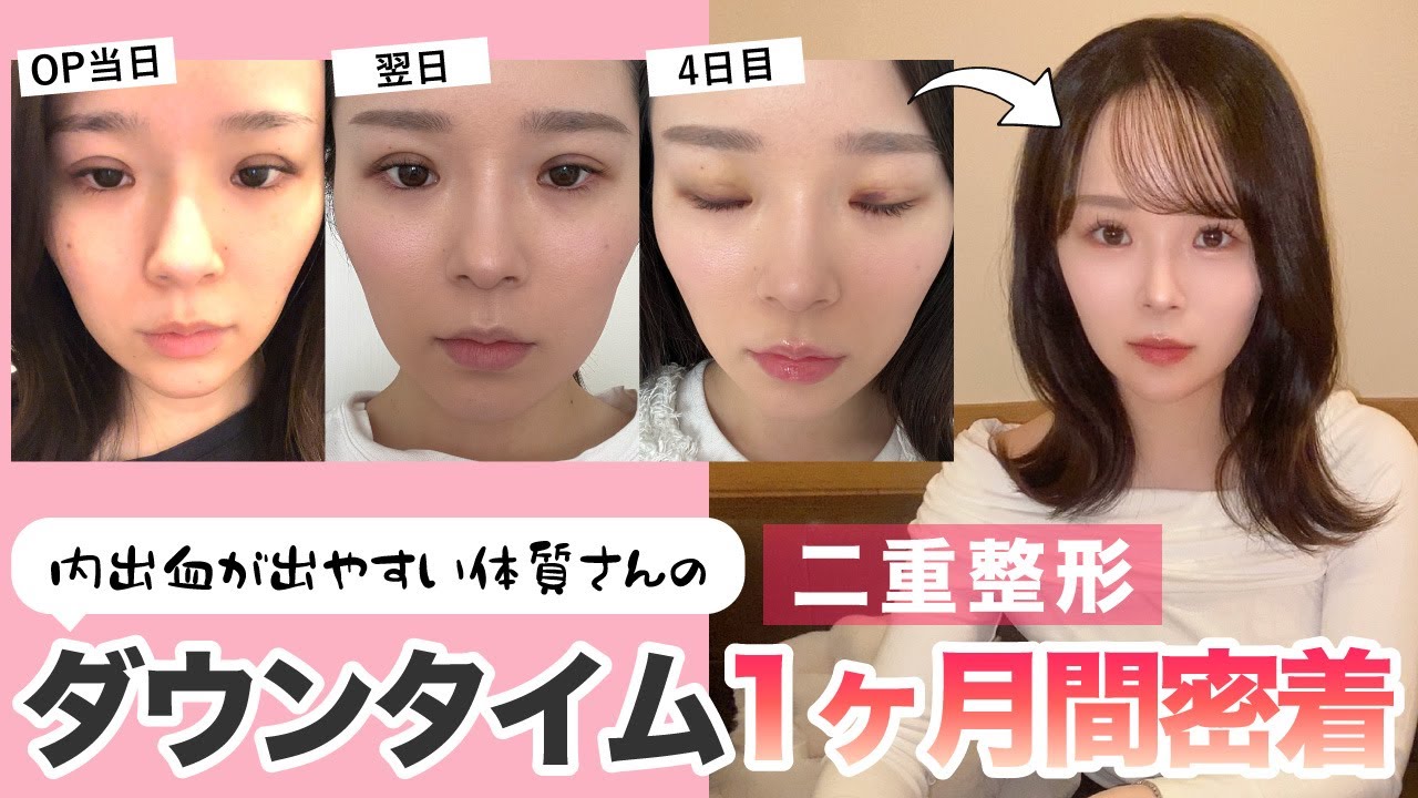 【ダウンタイム密着】新卒スタッフちゃんの二重整形密着後編！埋没二重整形の1ヶ月間の経過をまとめてみた