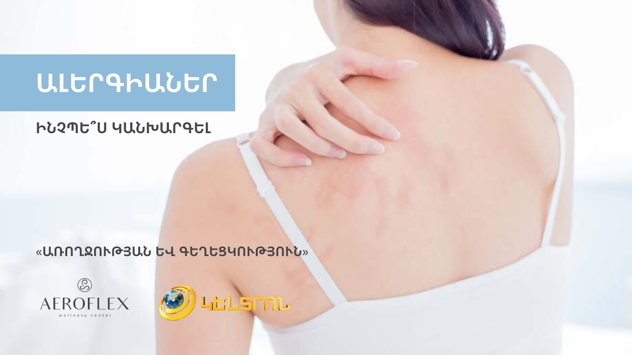 🔵Ալերգիաներ 👇 🔵Ինչպե՞ս կանխարգել 👩‍⚕