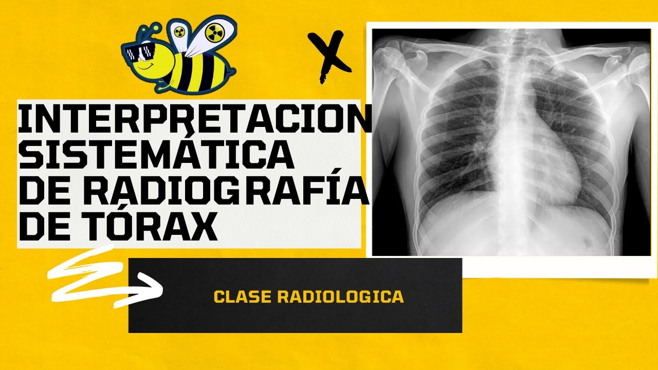 🟡⚫🚫 Interpretación sistemática de radiografía de tórax 🟡⚫🚫