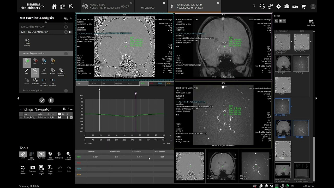 csf flow study #siemens #vida 3T