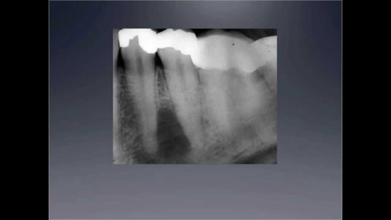 Is it endo? Periapical Leisons of the jaw (Dr. Eleni Gagari Interview Part II)