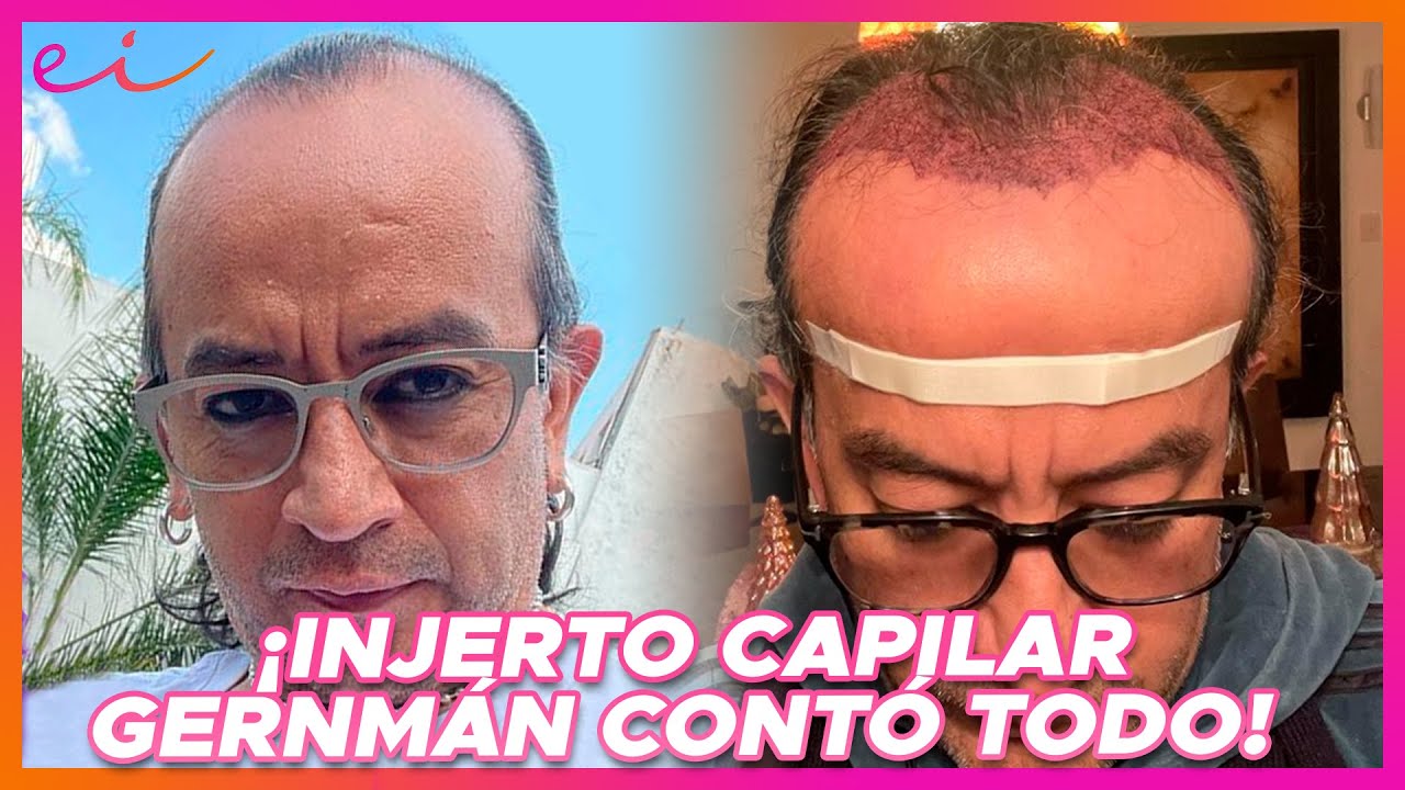 &iexcl;INJERTO CAPILAR! Germ&aacute;n Ortega Cont&oacute; TODA la verdad de su experiencia