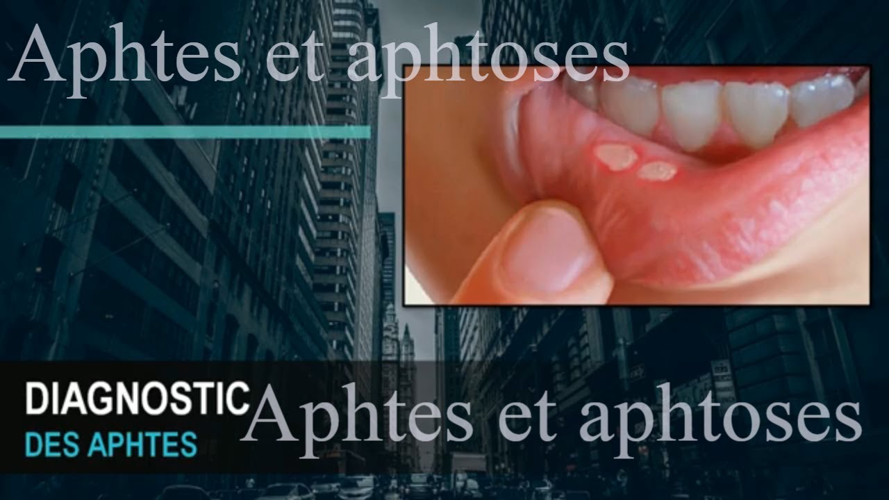 Aphtes et aphtoses : symptômes , etiologie , traitement