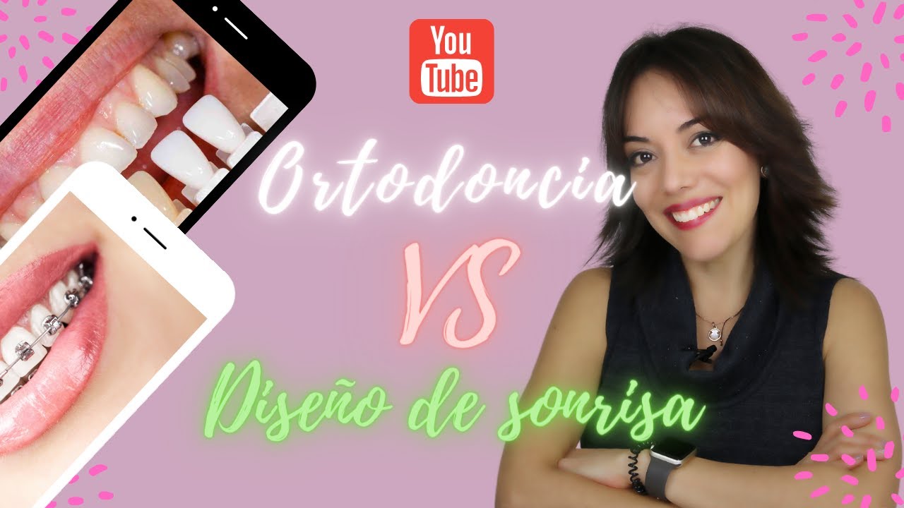 🥊 ORTODONCIA VS DISEÑO DE SONRISA🥊