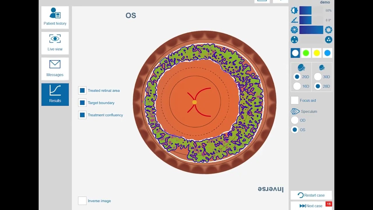 Eyesi Indirect ROP Laser Module – Assessment of treated area