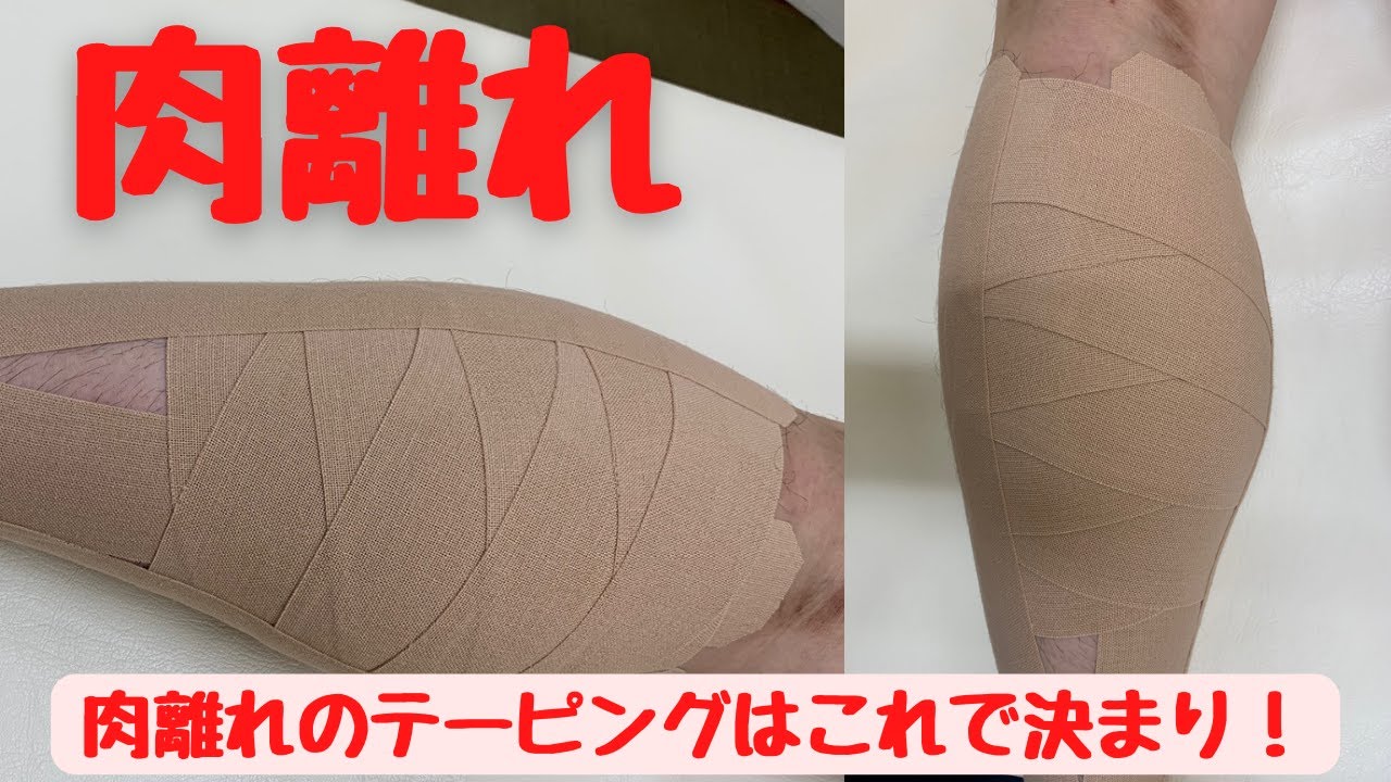 ふくらはぎの肉離れ（Ⅰ〜Ⅱ度）のテーピング（野球プレー中に負傷）