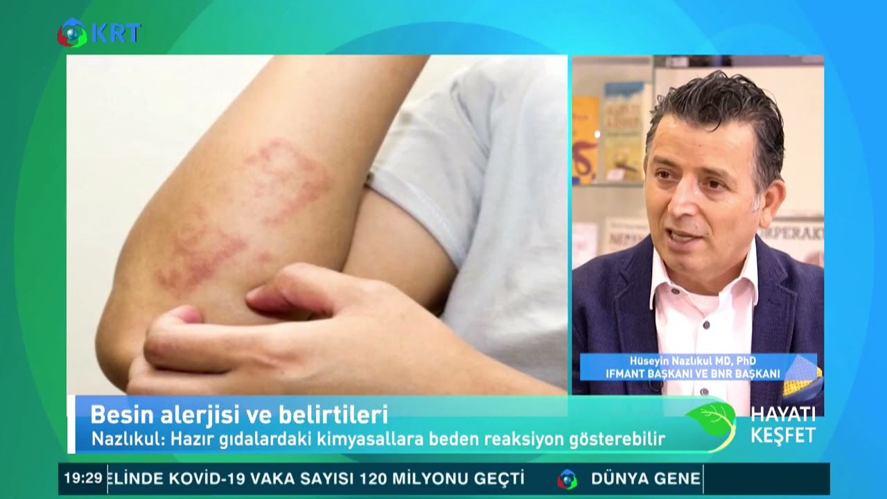 Besin Alerjisi Nedir  Belirtileri Nelerdir?