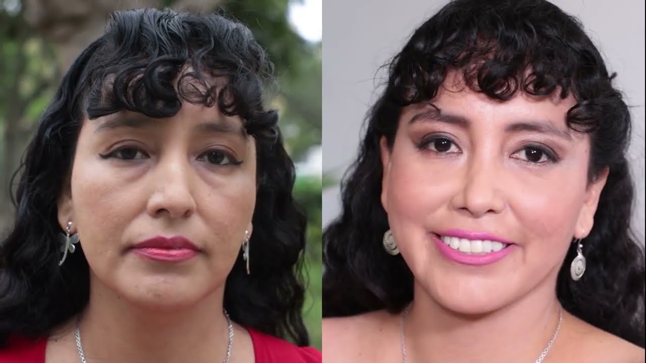 Procedimientos de la Rinoplastía Láser