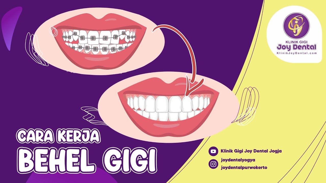 CARA KERJA BEHEL GIGI KENAPA BISA MERAPIKAN GIGI