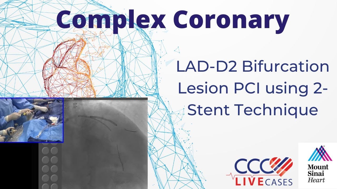 ЧКВ при бифуркации LAD-D2 с использованием техники двух стентов — CCC Live, октябрь 2016 г.