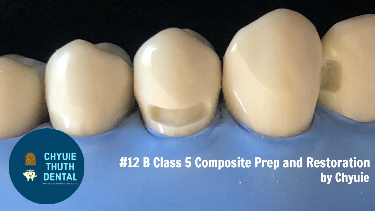 [ChyuieThuth] #12 B Class 5 Composite Prep and Restoration