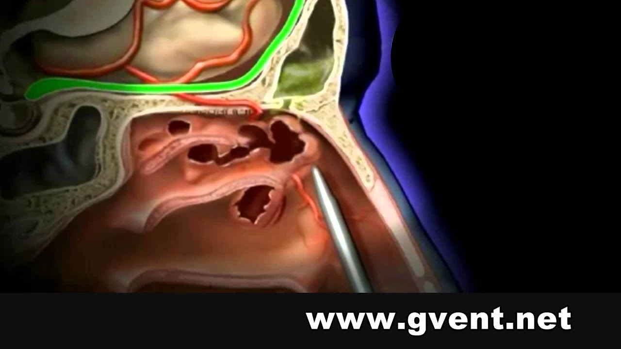Sinus Treatment In India | Sinusitis Cure Kerala | Modified Lothrop Procedure