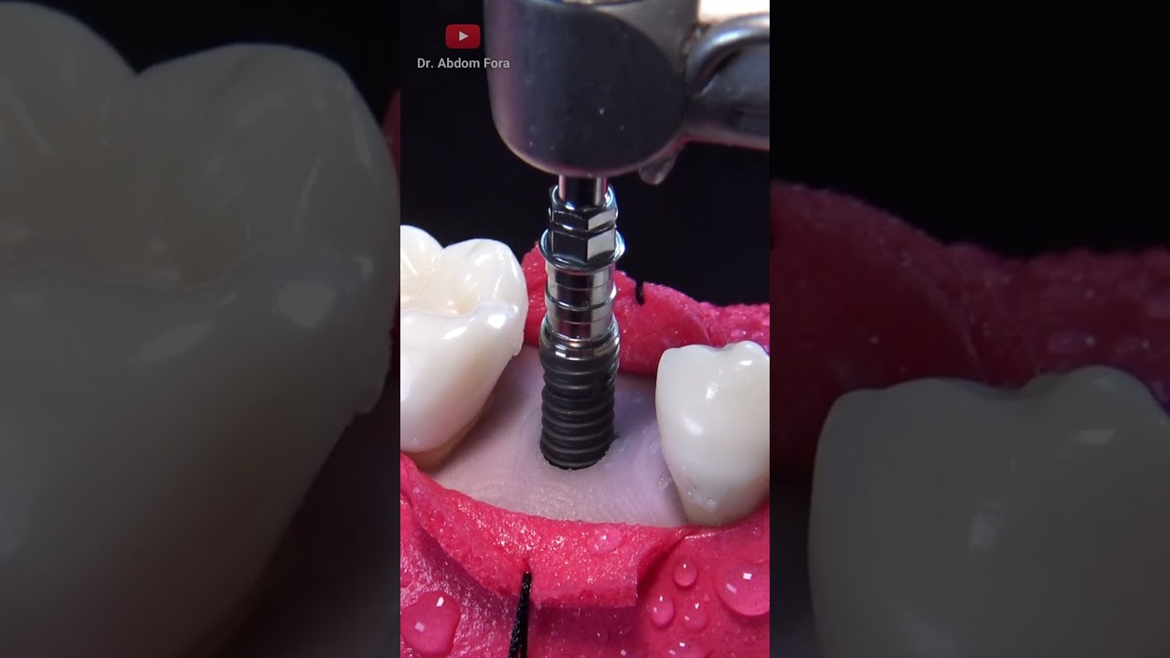 Implante dental en 4K
