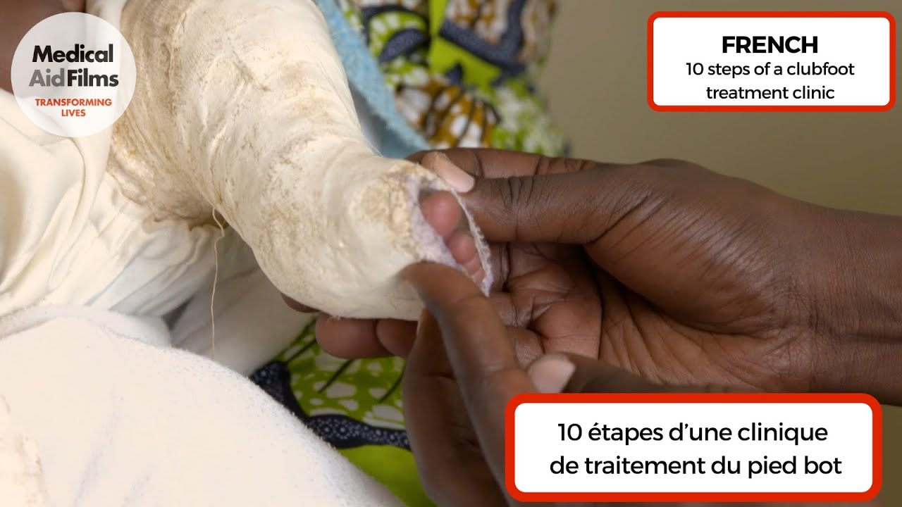10 étapes d’une clinique de traitement du pied bot.